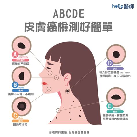 臉 長痣|健康網》長痣＝皮膚癌？ 醫提7症狀：善用ABCDE原。